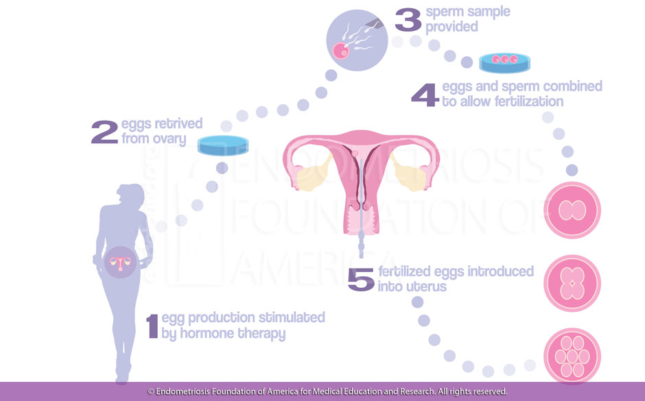 Scheme of in vitro fertilization