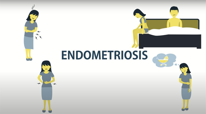 endometriosis symptoms