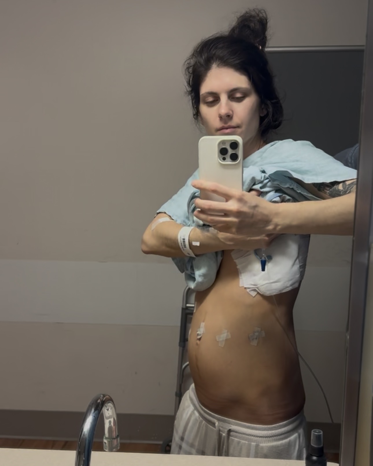 Priscilla Smith following her endometriosis excision surgery in February 2026