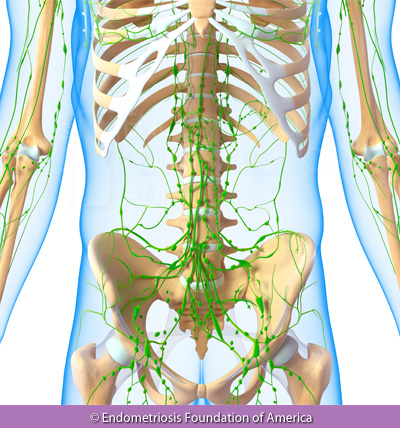 Endometriosis involvement with the lymphatic system