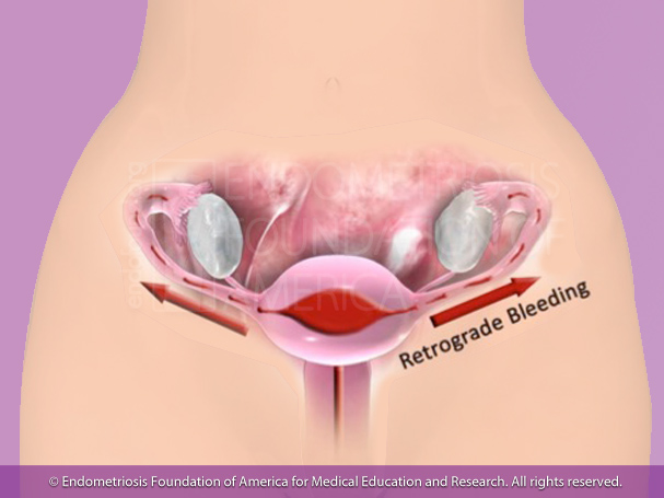 Sampson's Theory of Retrograde Menstruation