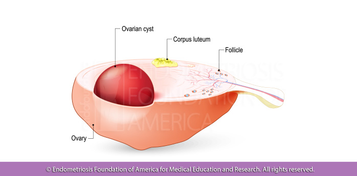 ovarian endometriomas (Chocolate cysts)