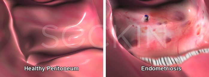 Peritoneal endometriosis