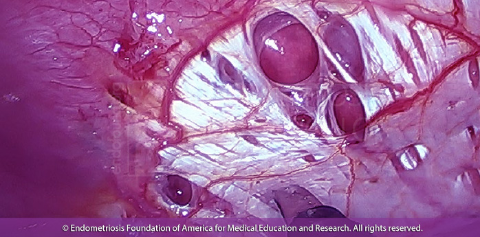 Thoracic Endometriosis Syndrome