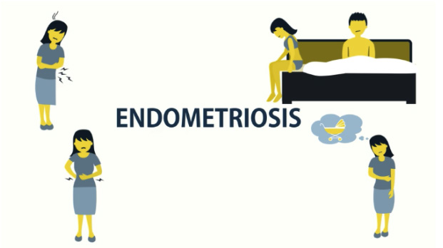 symptoms of endometriosis