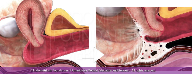 Endometriosis Symptoms: Flares, Periods, During Sex