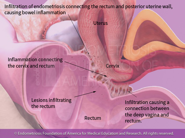 Clinical interpretation:     -Lesions to the posterior cul-de-sac