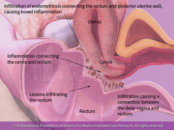 Endometriosis Symptoms: Gastrointestinal Distress