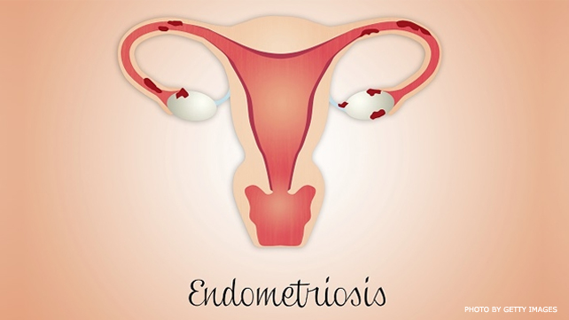 11 Things Only Someone With Endometriosis Understands