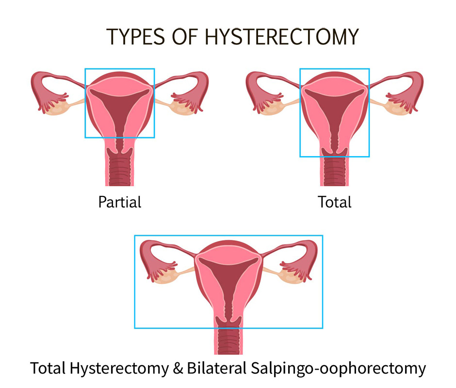 types of hysterectomy