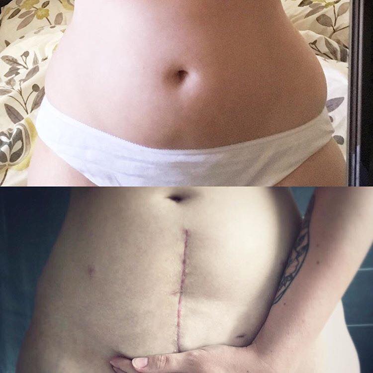 vertical incision scar