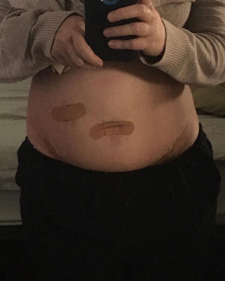 belly with bandaids
