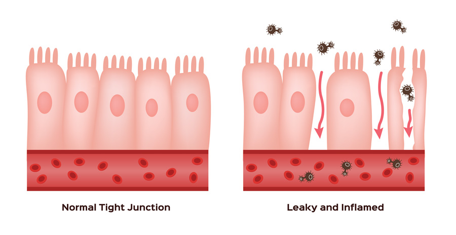 leaky gut