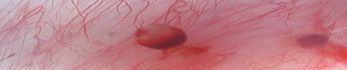 Endometriosis A-Z