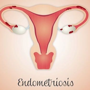 11 Things Only Someone With Endometriosis Understands