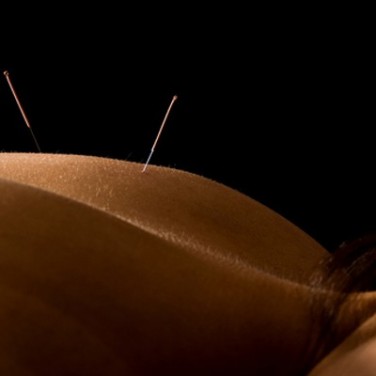 Endo Have You on Pins and Needles? An Acupuncturist May Have Your Answer 