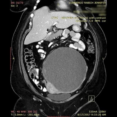 This New York Mom's Endometriosis Turned Into a Deadly Form of Ovarian Cancer  