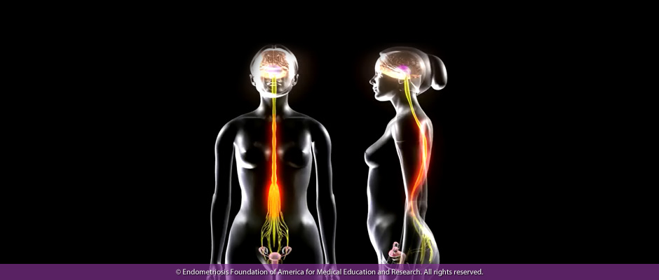 Endometriosis Symptoms: Neuropathy