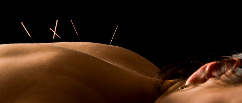 Endo Have You on Pins and Needles? An Acupuncturist May Have Your Answer