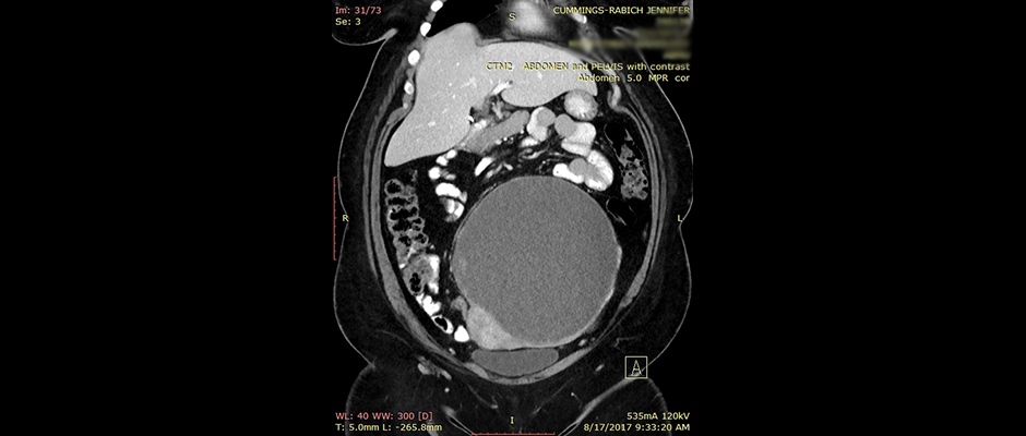 This New York Mom's Endometriosis Turned Into a Deadly Form of Ovarian Cancer  